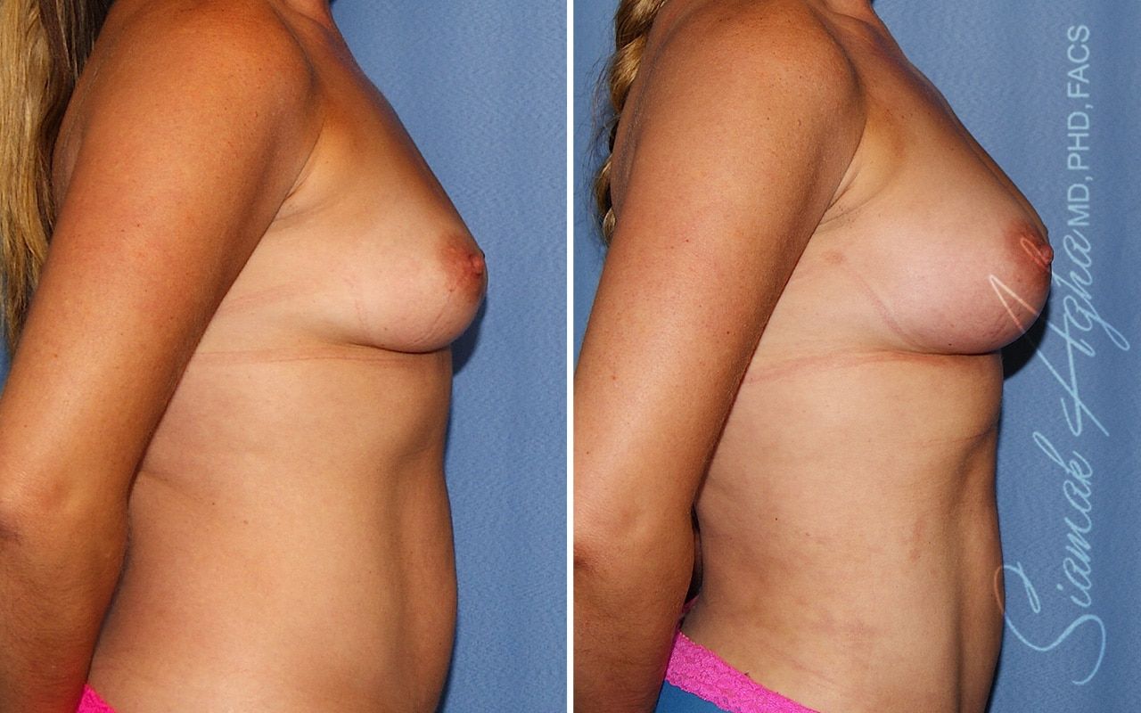 Breast Fat Transfer Before & After