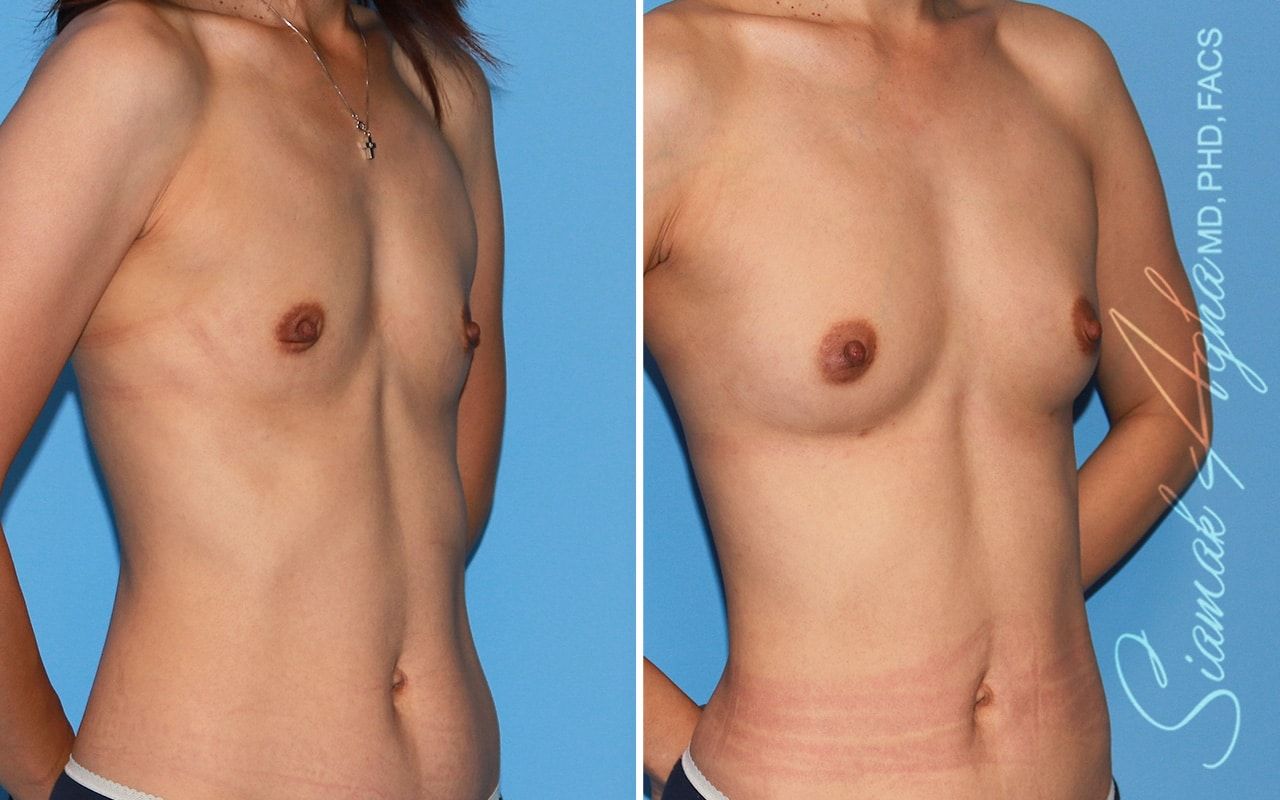 Breast Fat Transfer Before & After