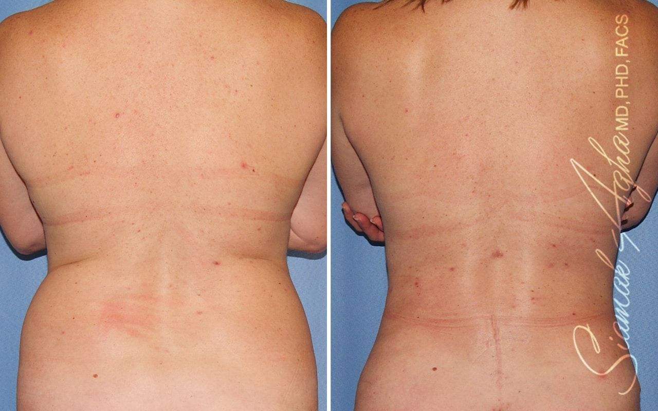Breast Fat Transfer Before & After
