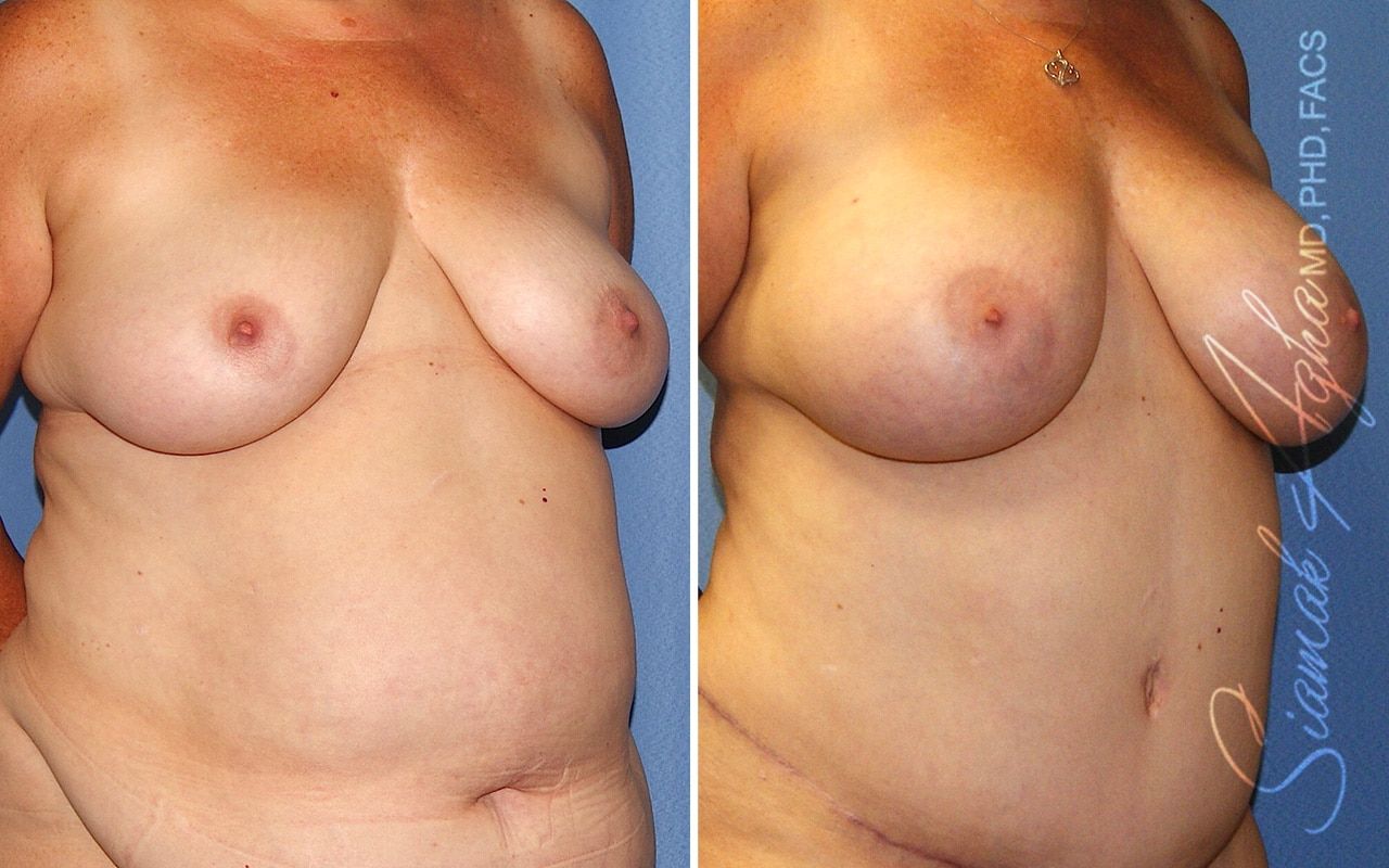 Breast Fat Transfer Before & After
