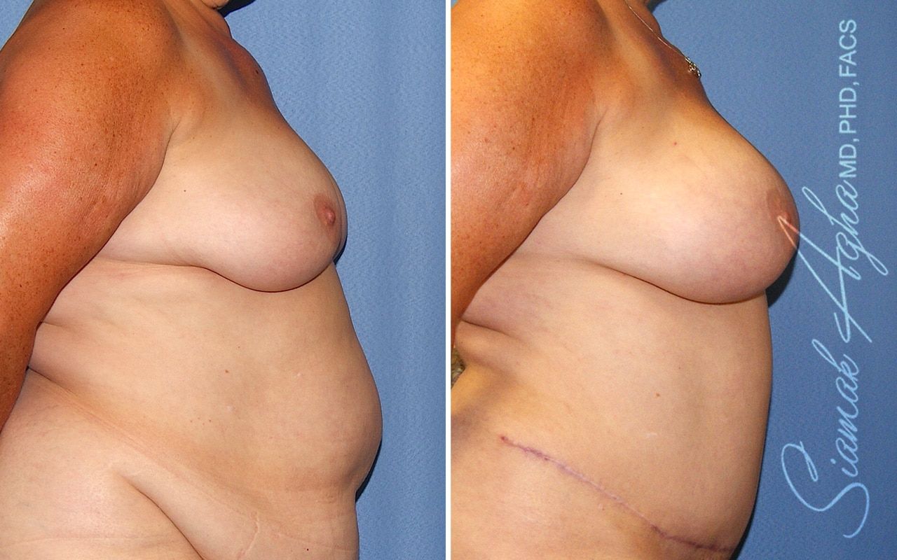 Breast Fat Transfer Before & After