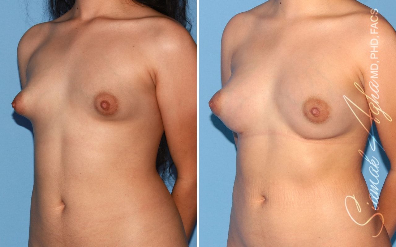 Breast Fat Transfer Before & After