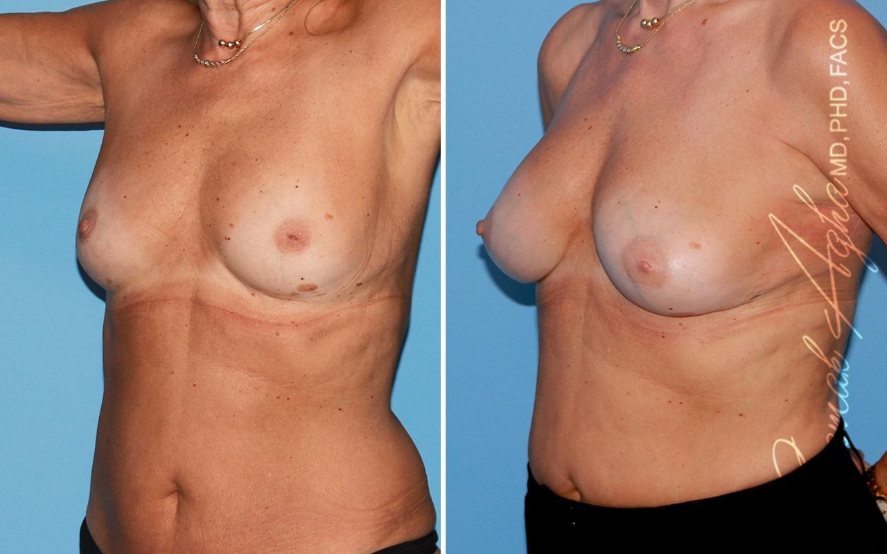 Breast Fat Transfer Before & After