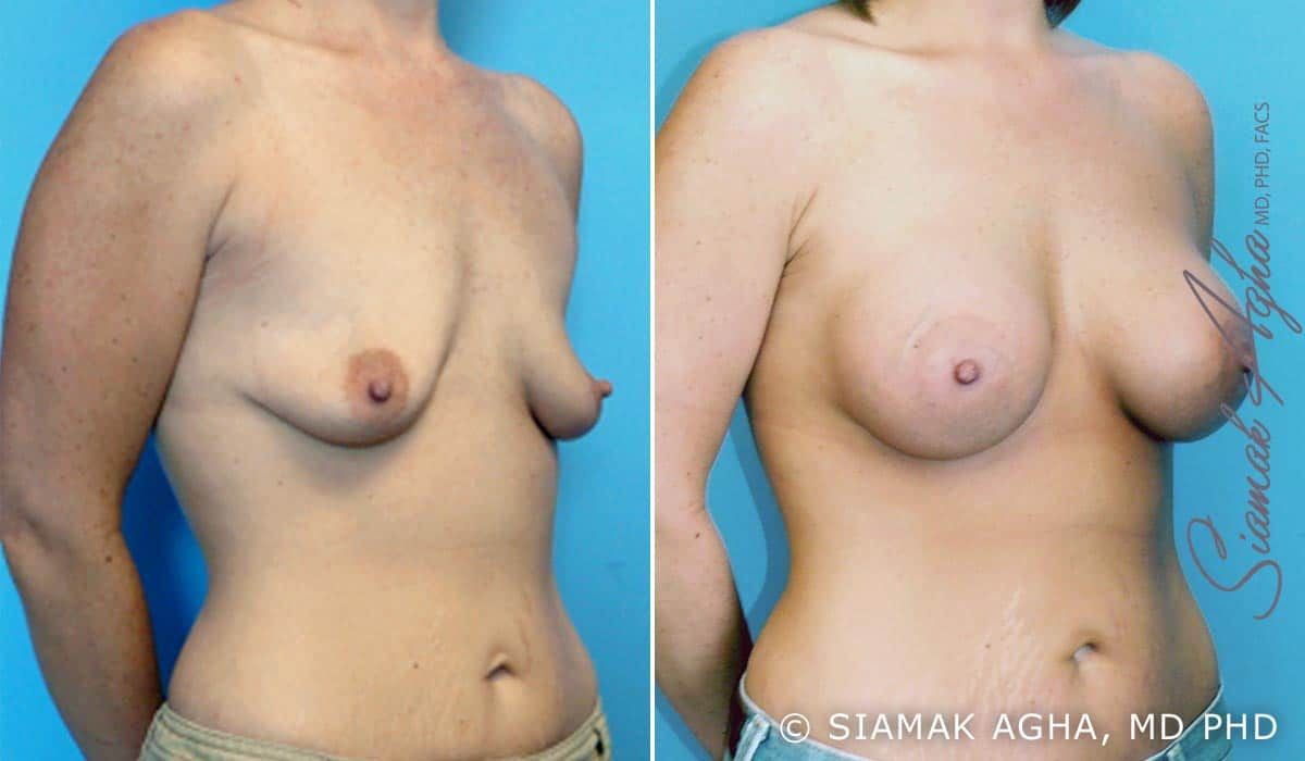 Breast Lift With Augmentation Before & After