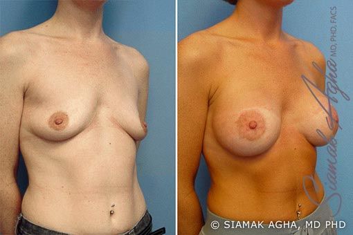 Breast Lift With Augmentation Before & After