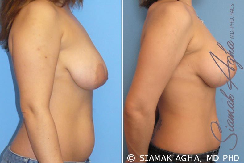 Breast Lift With Augmentation Before & After