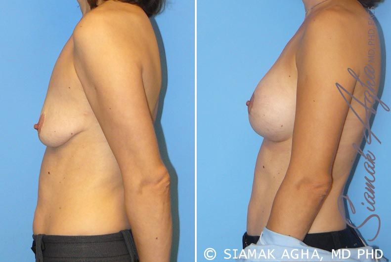 Breast Lift With Augmentation Before & After