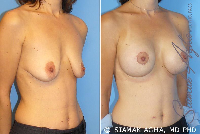 Breast Lift With Augmentation Before & After
