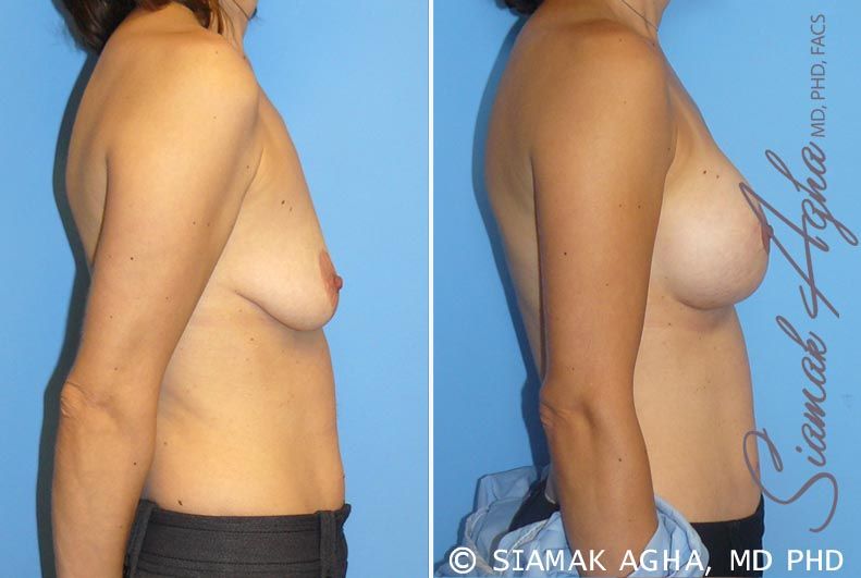 Breast Lift With Augmentation Before & After