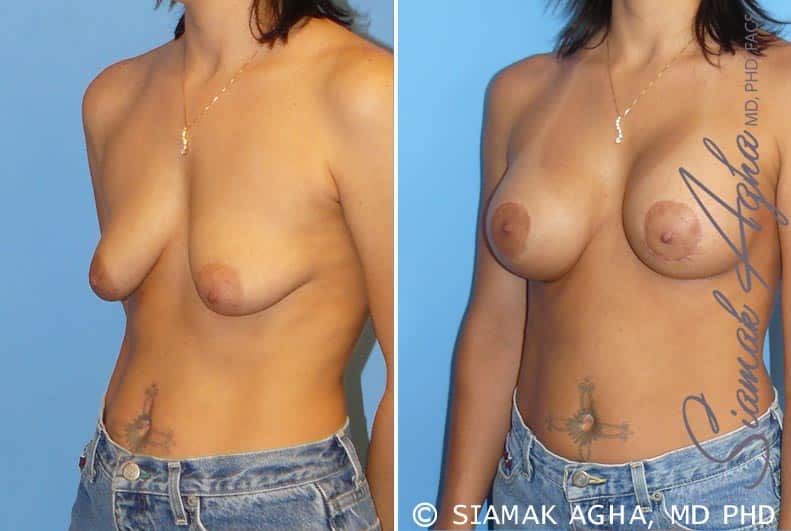 Breast Lift With Augmentation Before & After