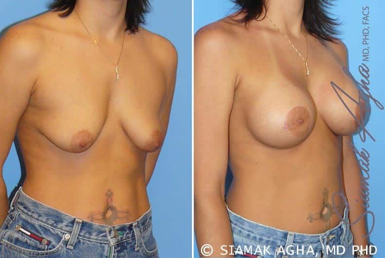 Breast Lift With Augmentation Before & After