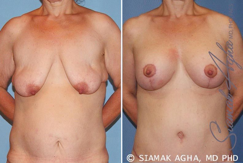 Breast Lift With Augmentation Before & After
