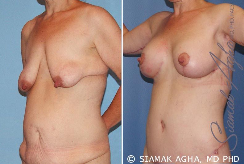 Breast Lift With Augmentation Before & After