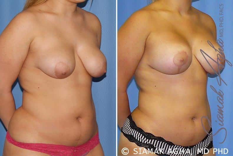 Breast Lift With Augmentation Before & After