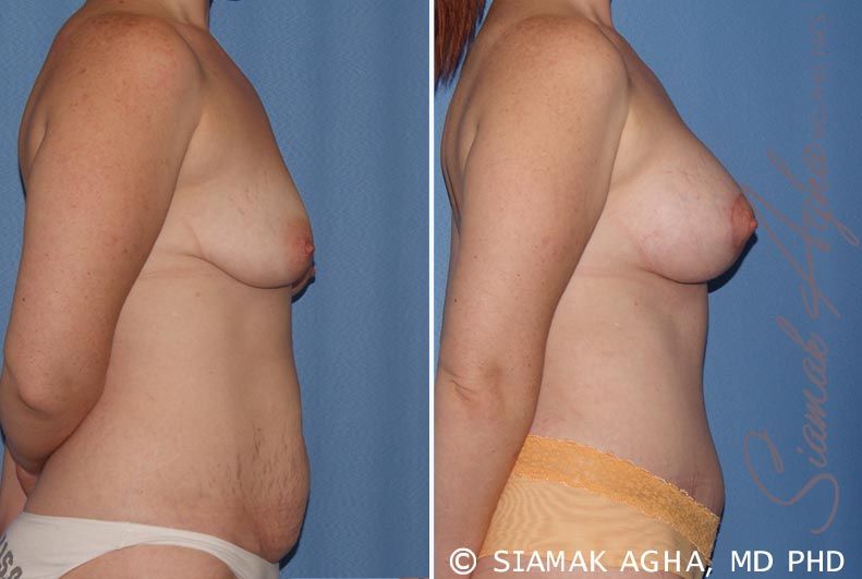 Breast Lift With Augmentation Before & After
