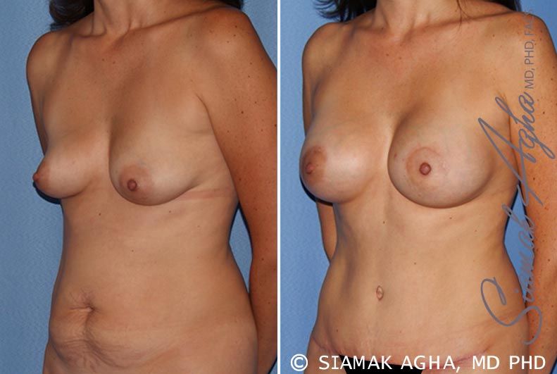 Breast Lift With Augmentation Before & After