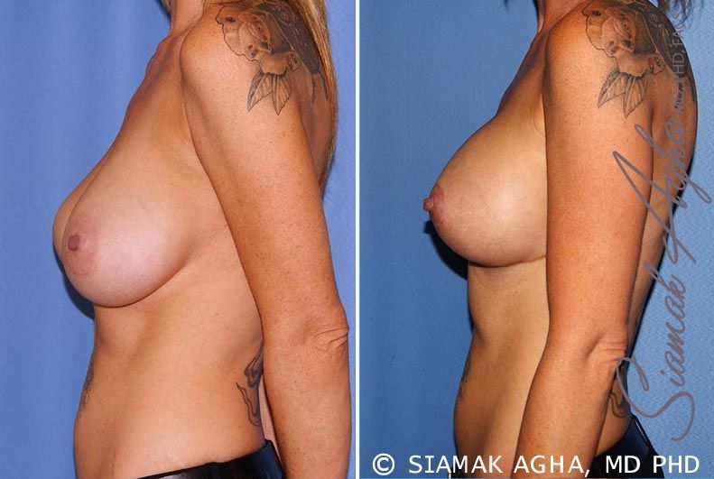Breast Lift With Augmentation Before & After