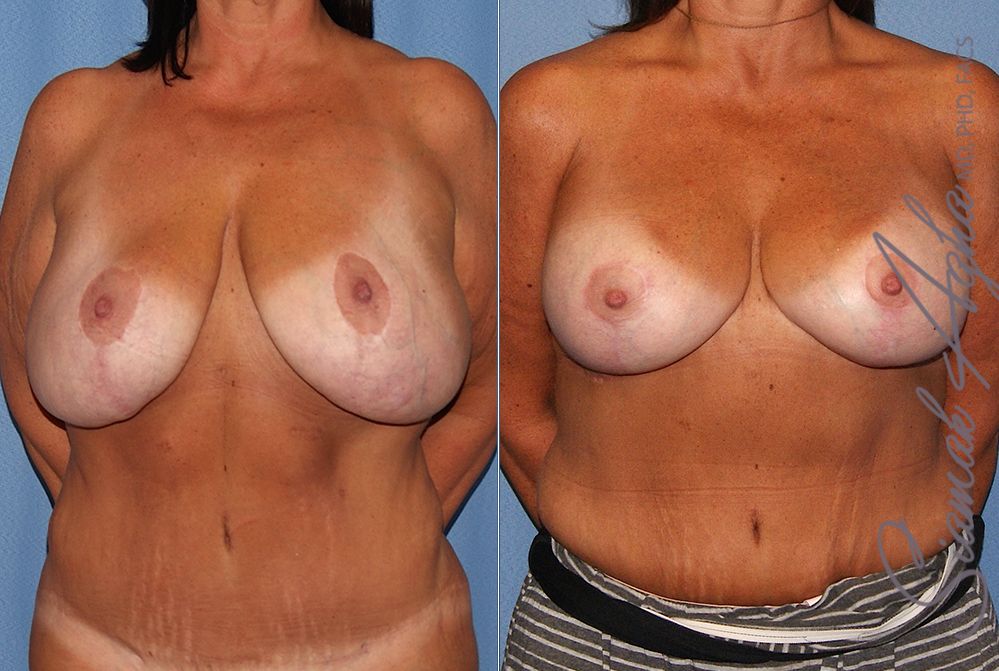 Breast Lift With Augmentation Before & After