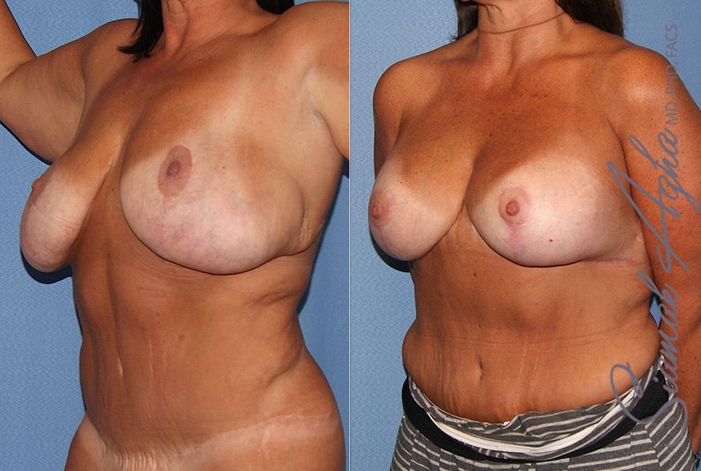 Breast Lift With Augmentation Before & After