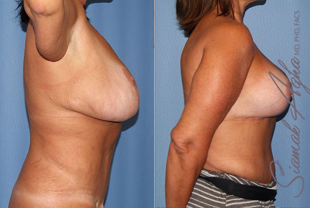 Breast Lift With Augmentation Before & After