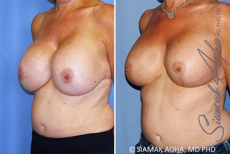 Breast Lift With Augmentation Before & After