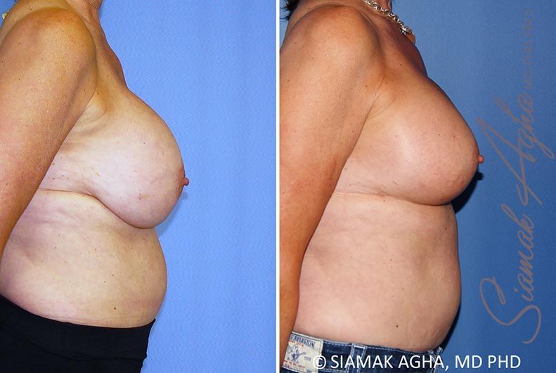 Breast Lift With Augmentation Before & After