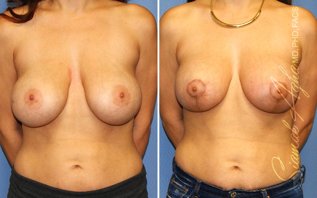 Breast Lift With Augmentation Before & After
