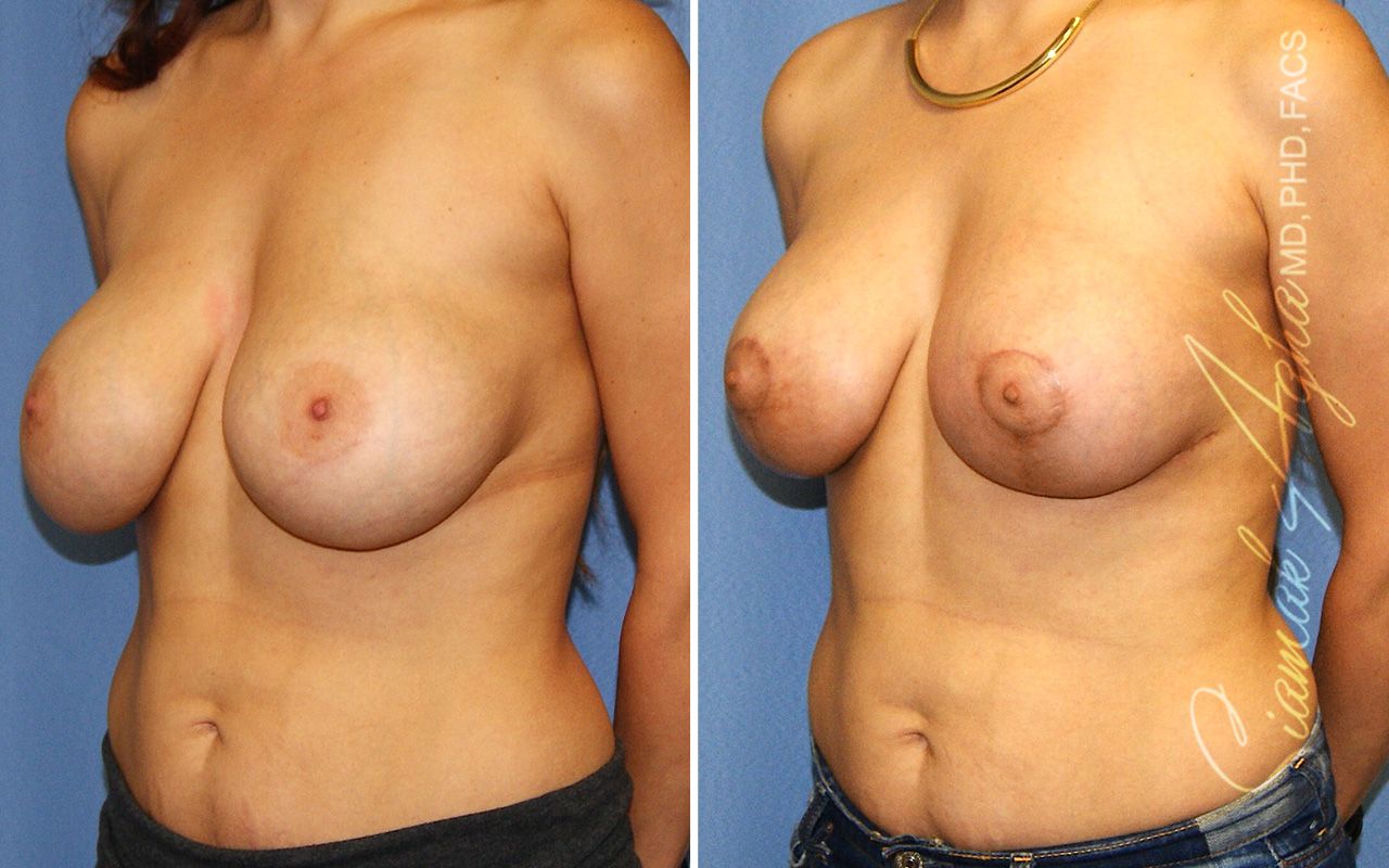 Breast Lift With Augmentation Before & After