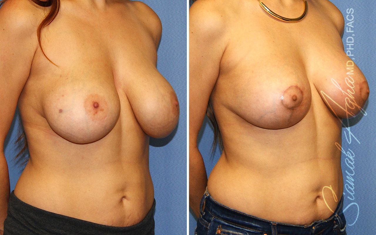 Breast Lift With Augmentation Before & After