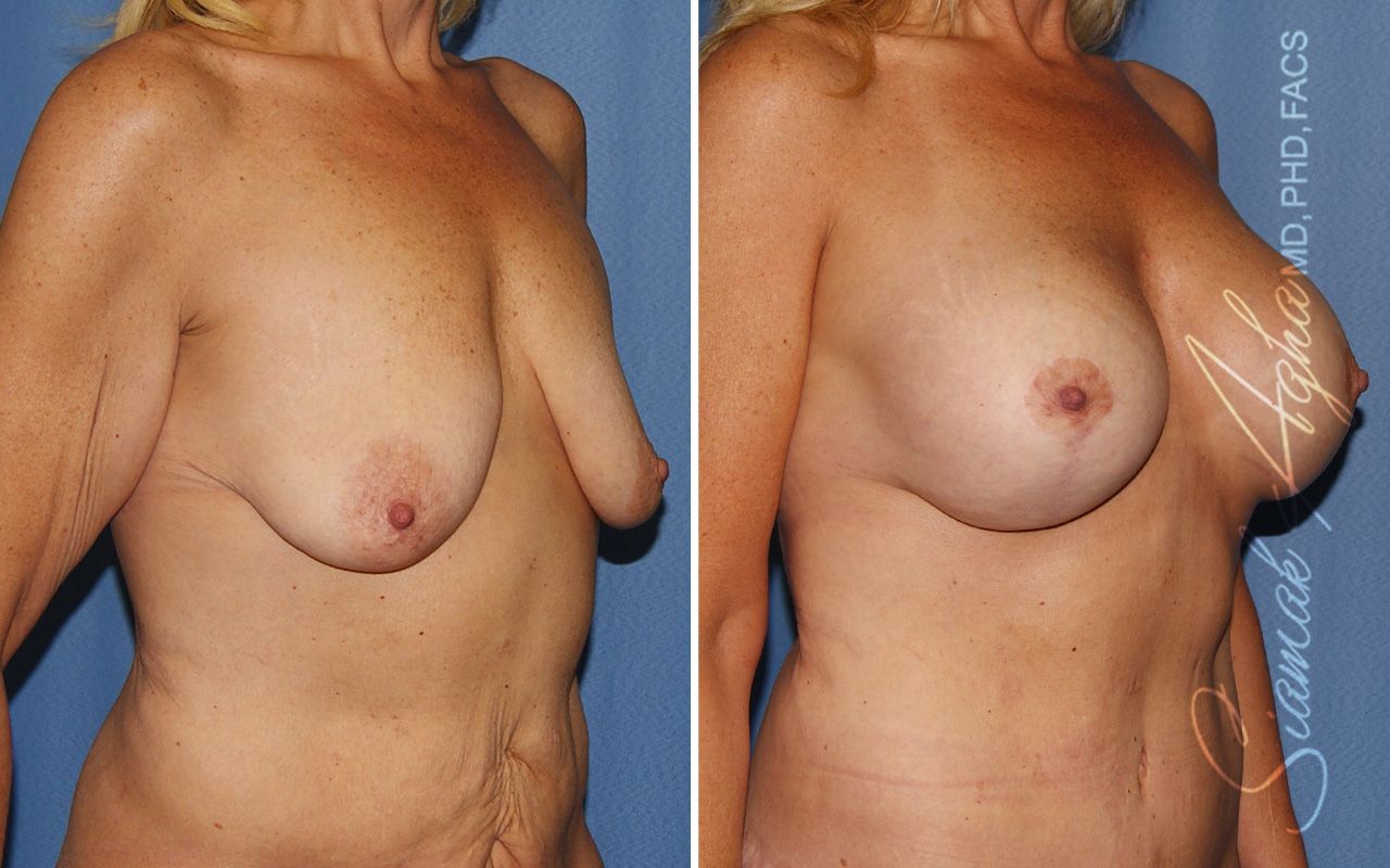 Breast Lift With Augmentation Before & After
