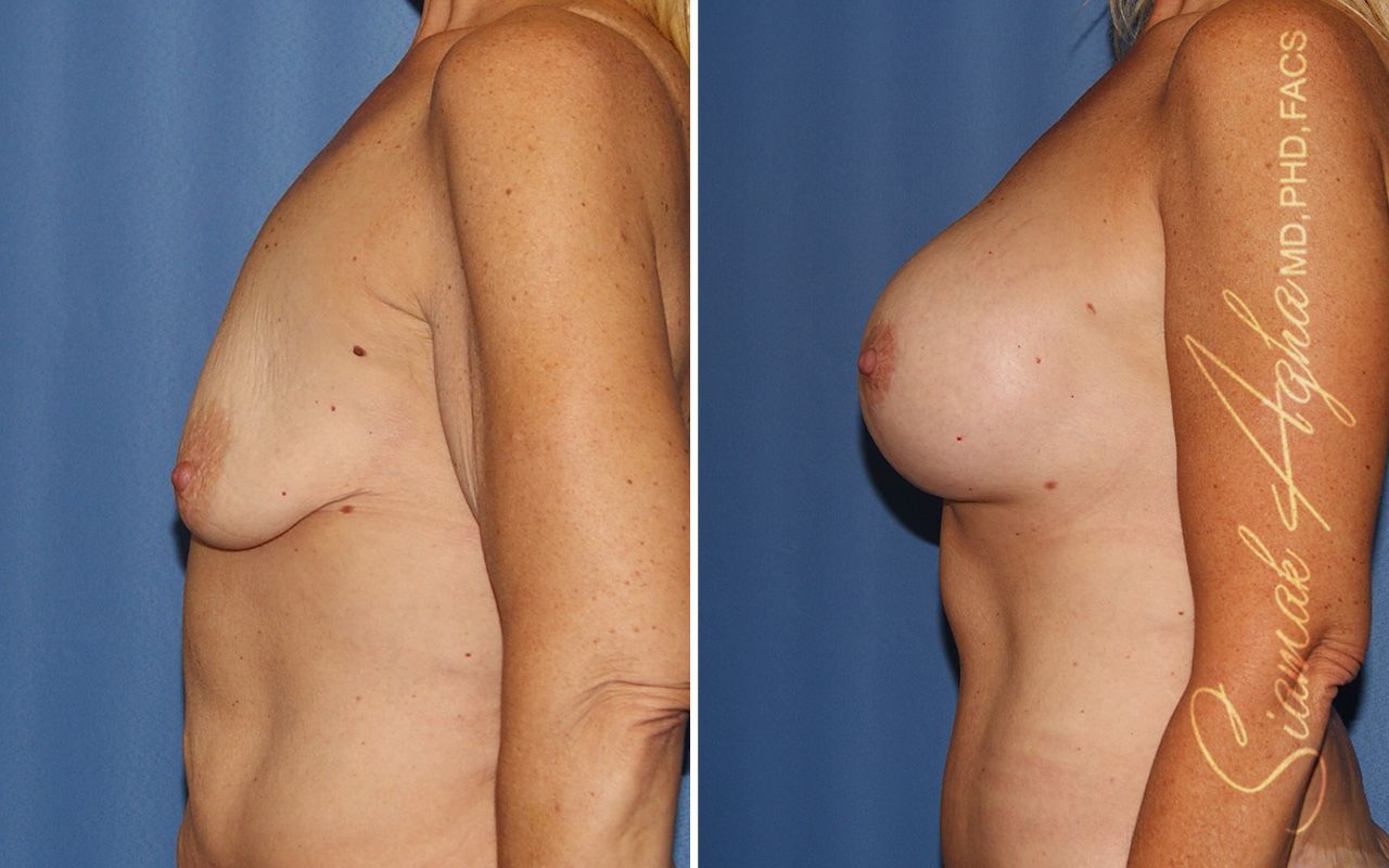 Breast Lift With Augmentation Before & After