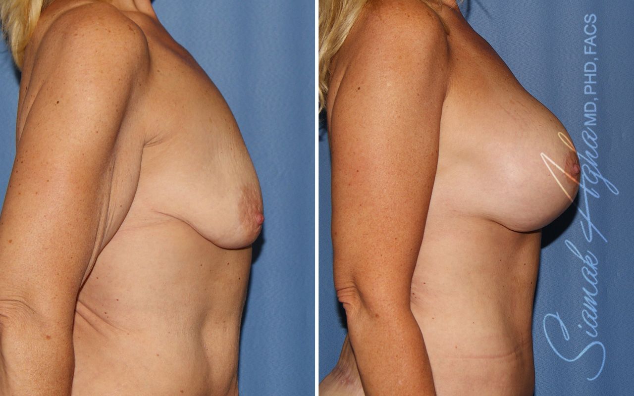 Breast Lift With Augmentation Before & After