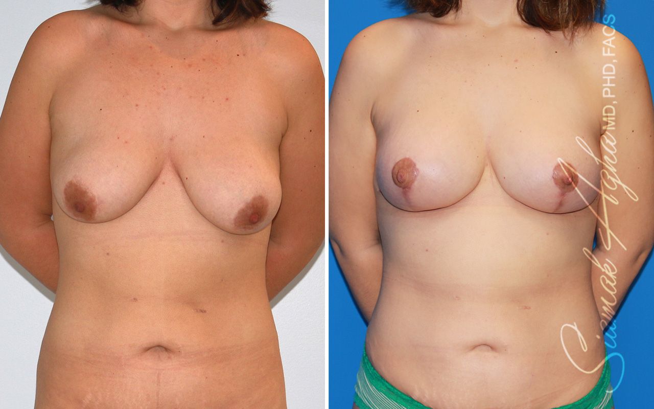 Breast Lift With Augmentation Before & After