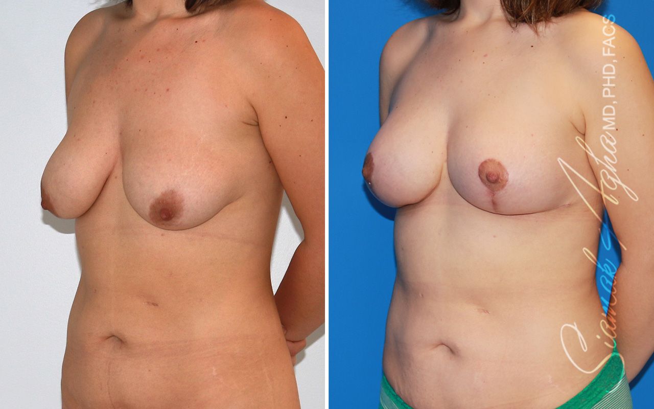 Breast Lift With Augmentation Before & After