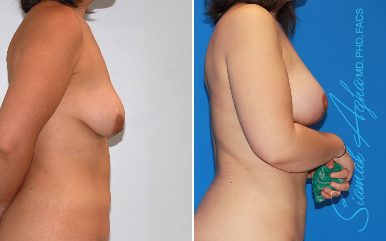 Breast Lift With Augmentation Before & After