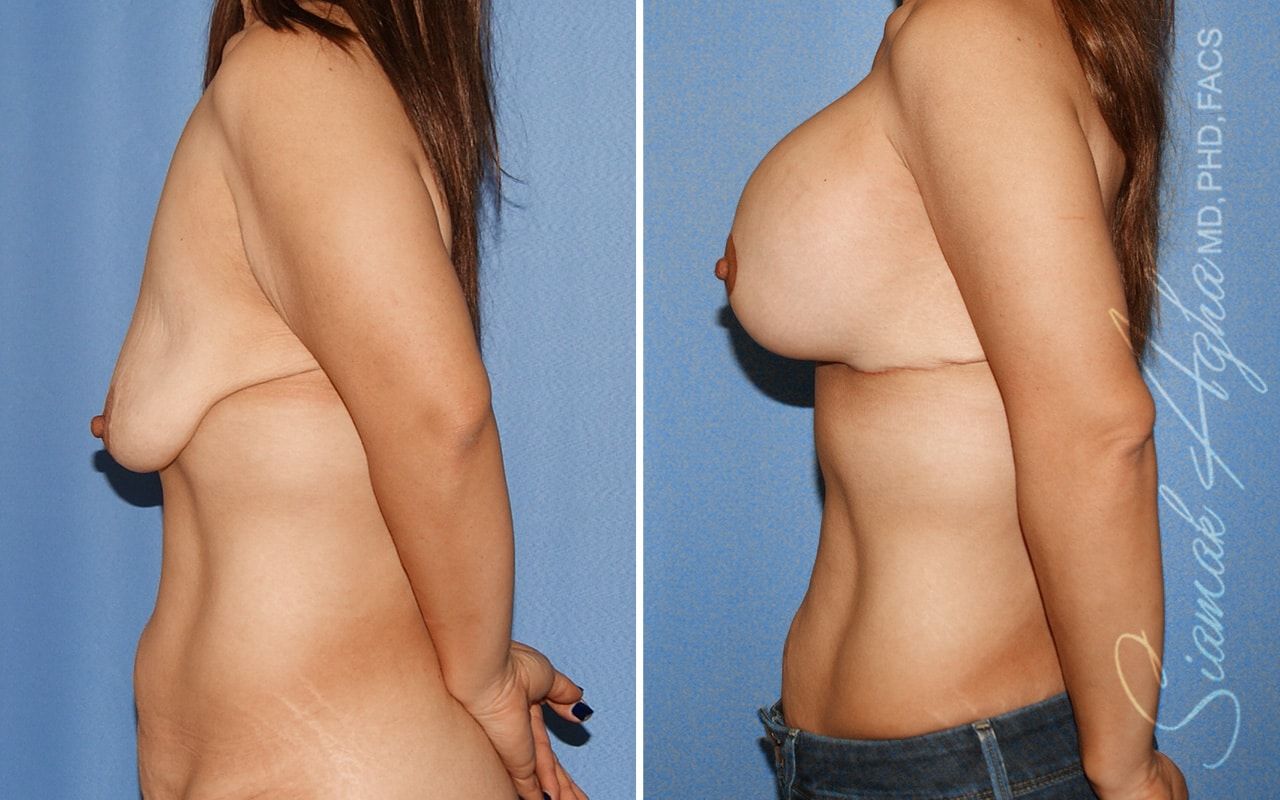 Breast Lift With Augmentation Before & After