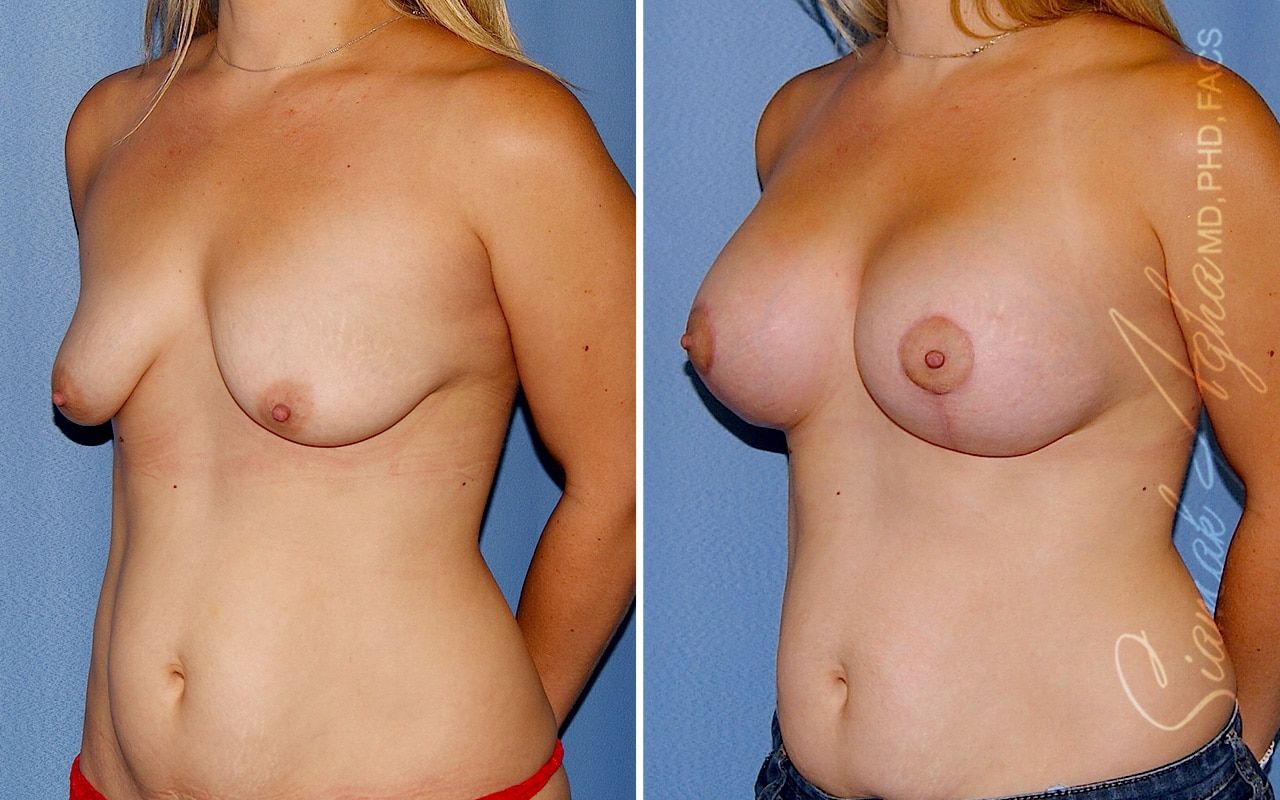 Breast Lift With Augmentation Before & After