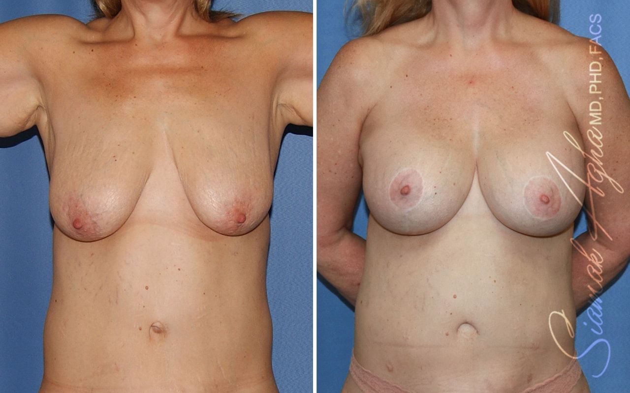 Breast Lift With Augmentation Before & After