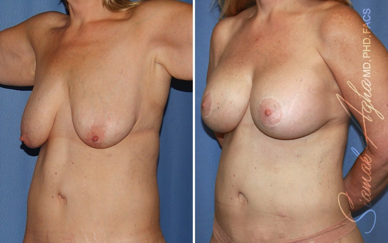 Breast Lift With Augmentation Before & After