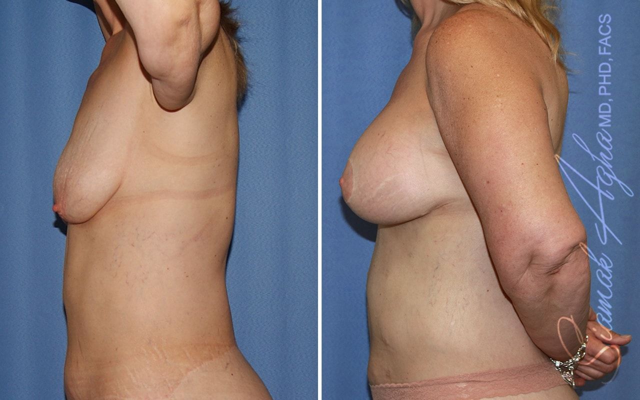 Breast Lift With Augmentation Before & After