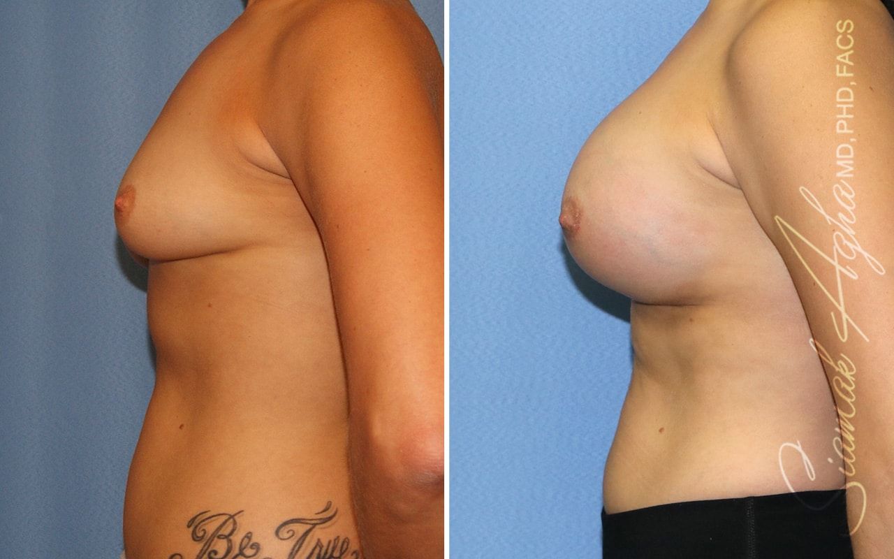 Breast Lift With Augmentation Before & After