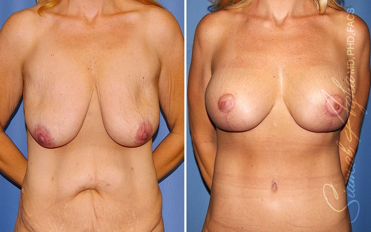 Breast Lift With Augmentation Before & After