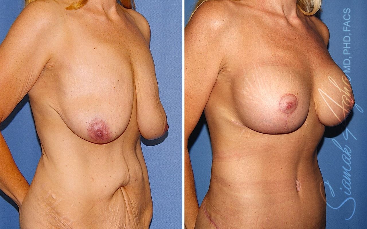 Breast Lift With Augmentation Before & After