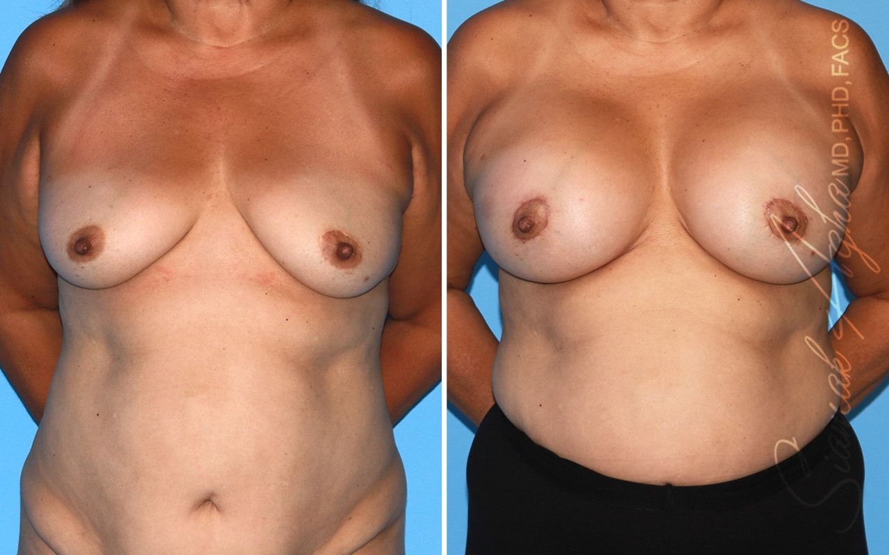 Breast Lift With Augmentation Before & After