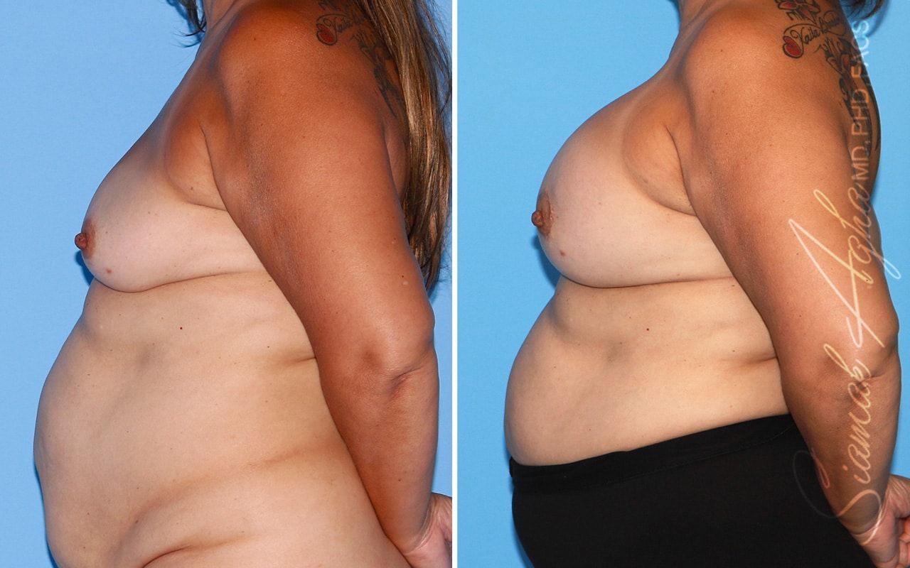 Breast Lift With Augmentation Before & After