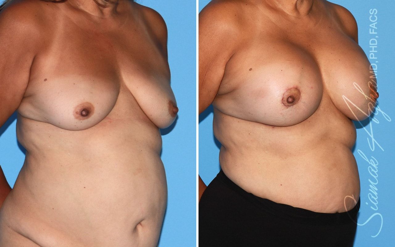 Breast Lift With Augmentation Before & After