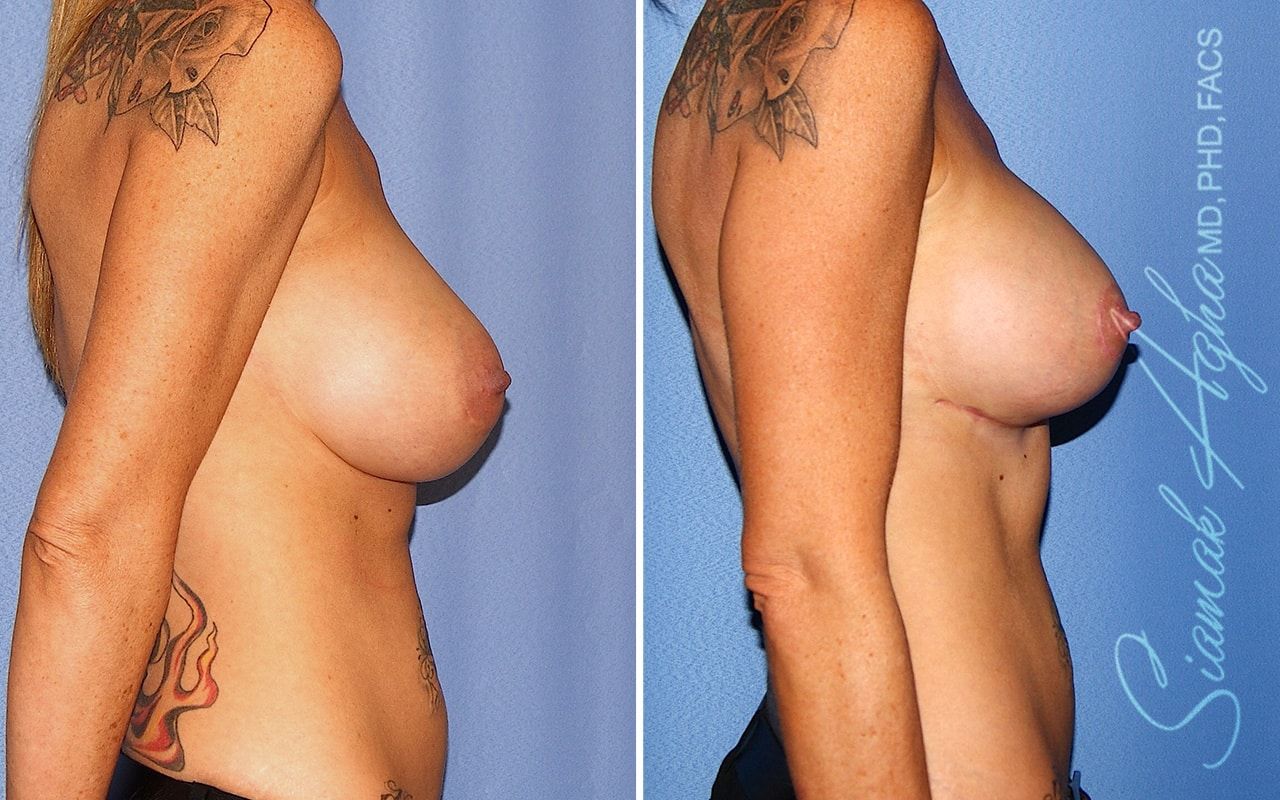 Breast Lift With Augmentation Before & After