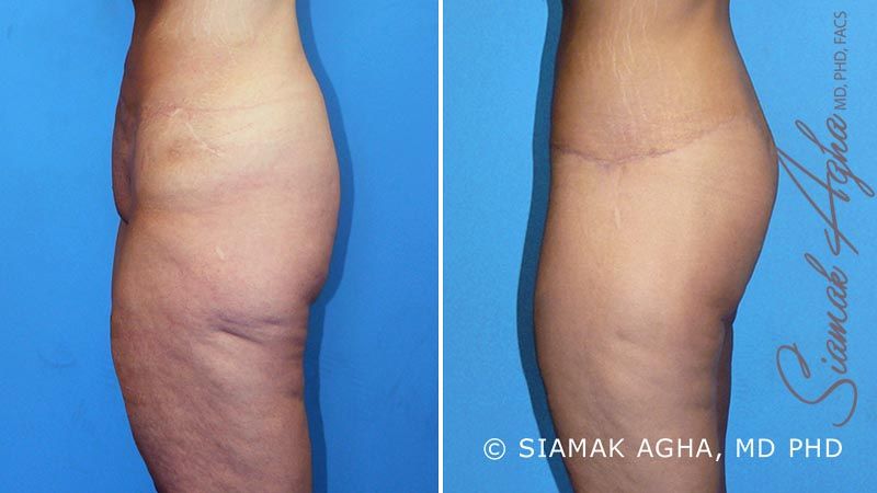 Vertical Thigh Lift Before & After