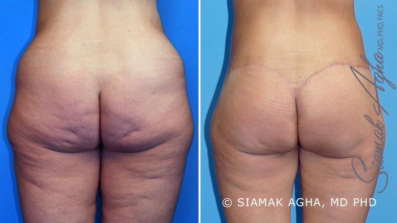 Vertical Thigh Lift Before & After