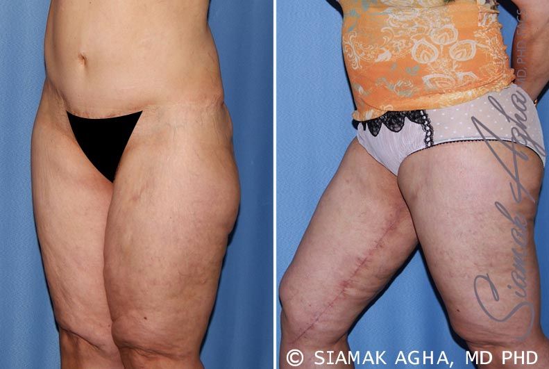 Vertical Thigh Lift Before & After